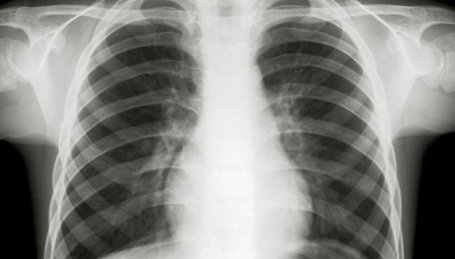 Imagem Raio X do tórax referência a Pneumonia